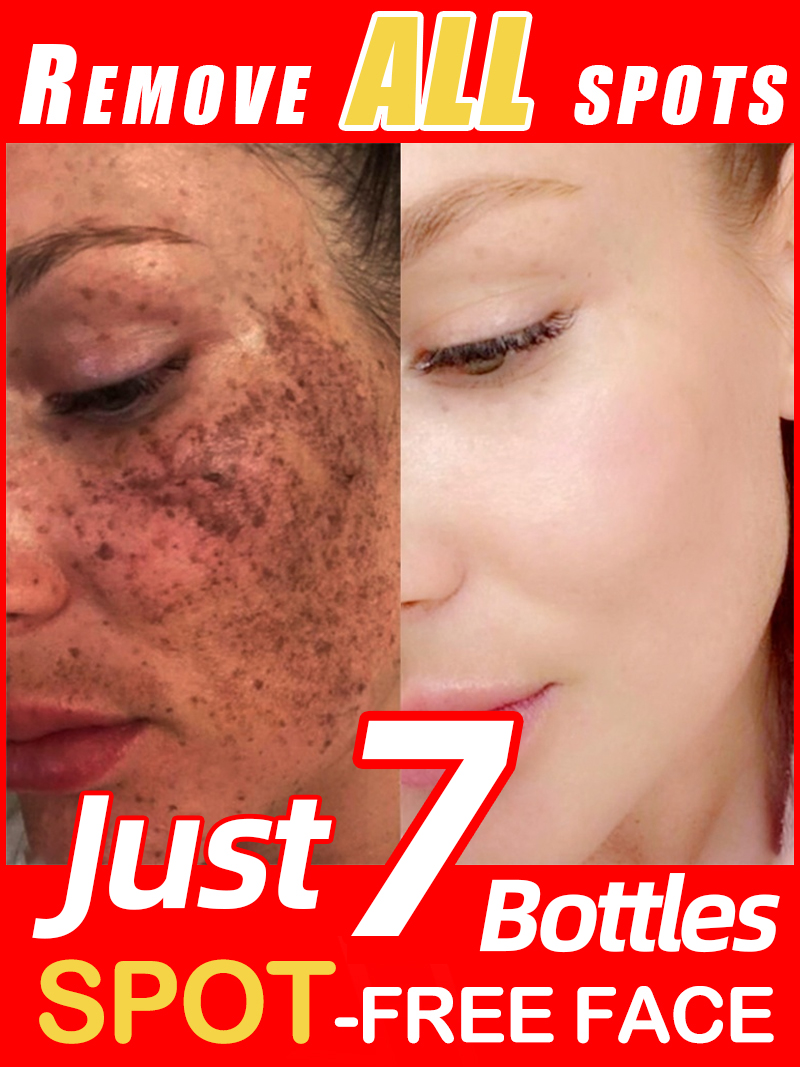 Lighten Freckles Melasma, Faci - огляд і ціна Skincare Luxury Whitening